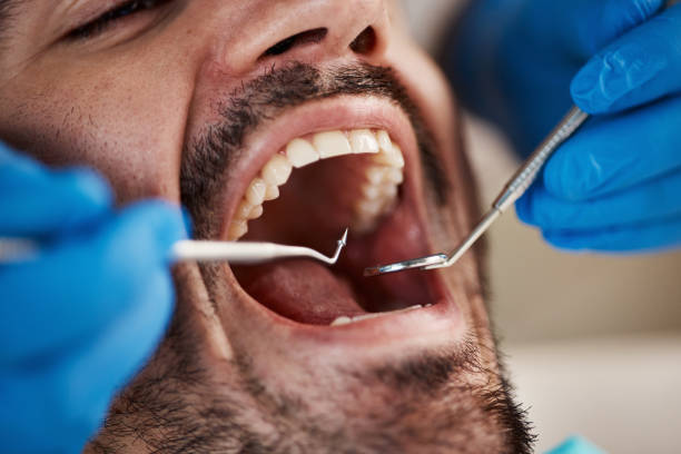 Best Knocked-Out Tooth Emergency  in Orosi, CA